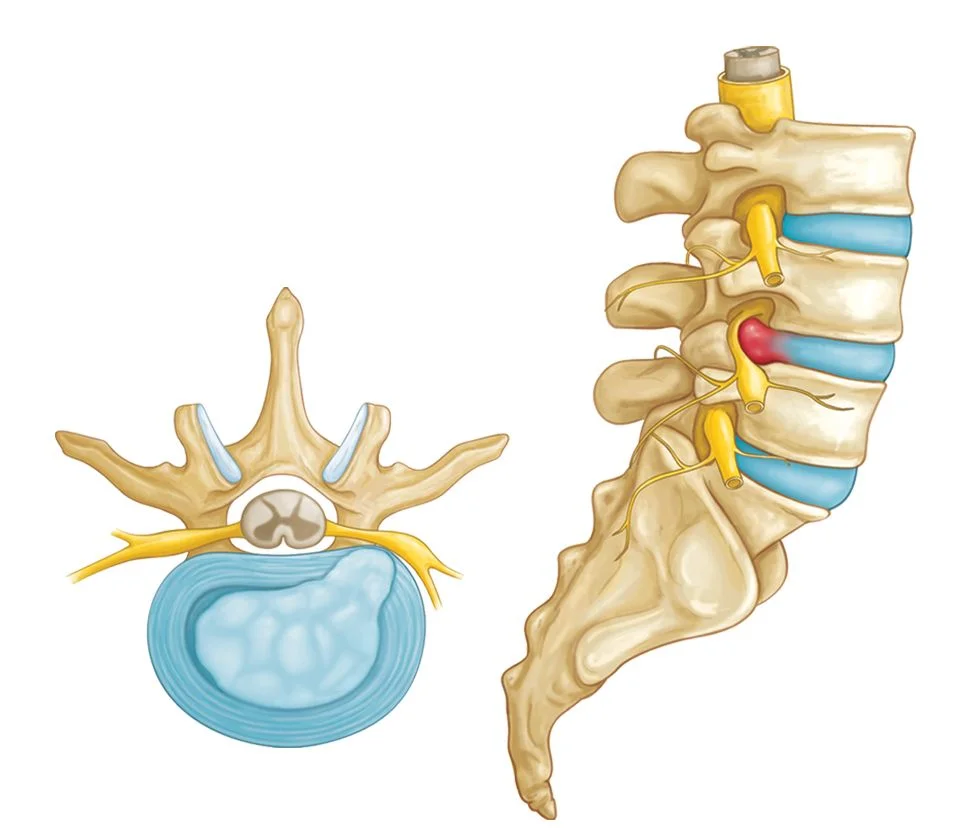 spinal stenosis treatment in Mumbai