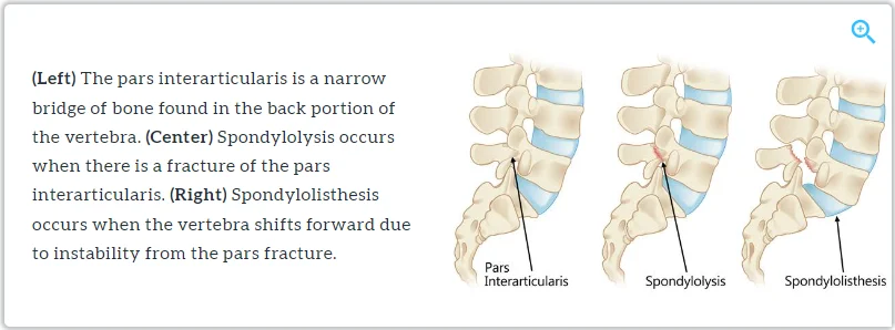 spondylolysis treatment in Mumbai