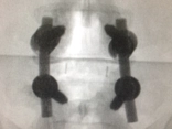 rods and screws in back surgery