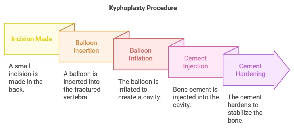 Kyphoplasty procedure