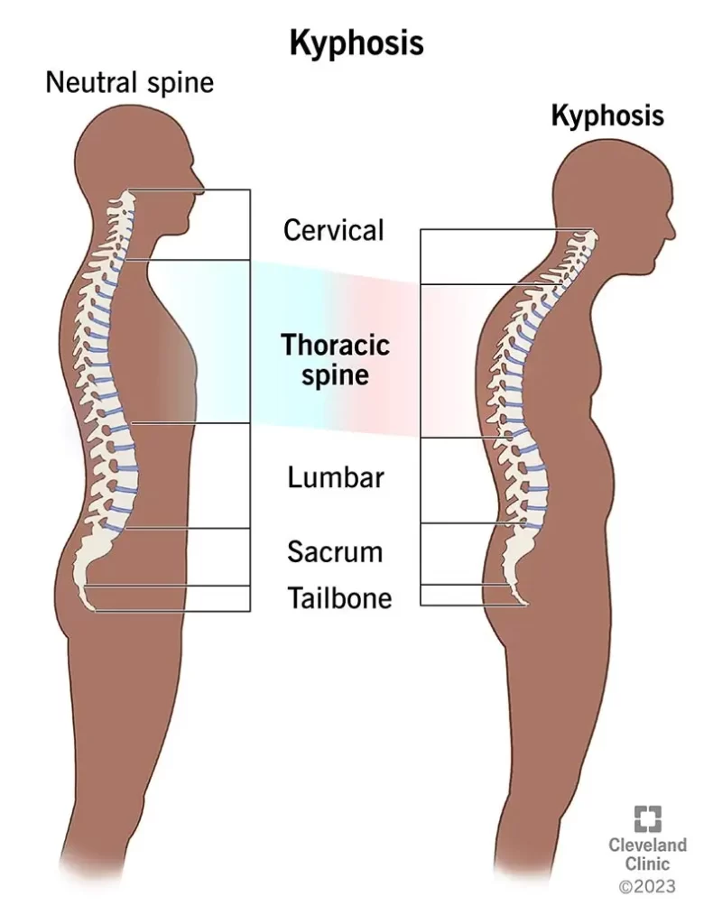 kyphosis description